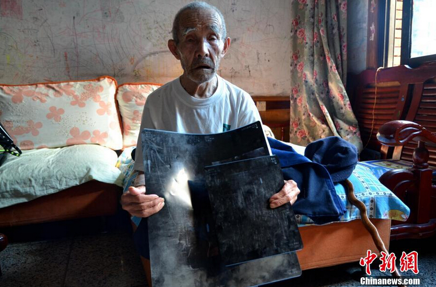 94-летний ветеран антияпонской войны 60 лет прожил с пулей в подвздошной кости