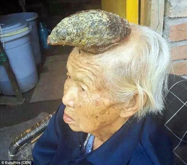 На голове 87-летней женщины вырос рог