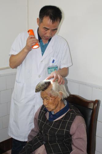На голове 87-летней женщины вырос рог