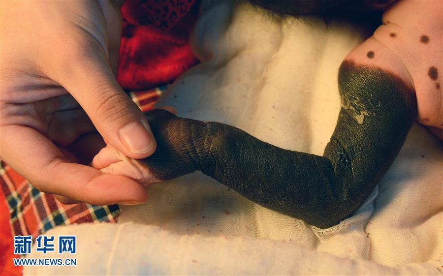 Грудная девочка в провинции Хэбэй заболела редкой кожной болезнью