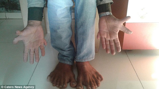 Человек с самым большим в мире количеством пальцев на руках и ногах