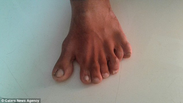 Человек с самым большим в мире количеством пальцев на руках и ногах