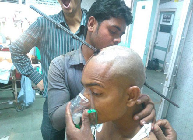 Индийскому рабочему чудом удалось выжить после пробивания головы арматурой
