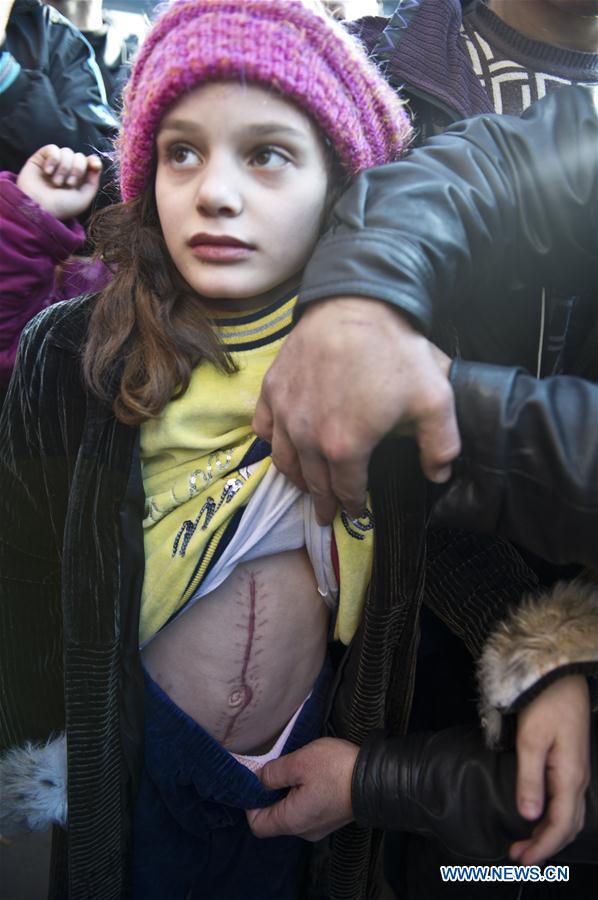 На фото: 29 декабря 2011 года в Хомсе огромный шрам остался на животе девочки, которая была раненой в вооруженных конфликтах. (Синьхуа/Ли Муцы)