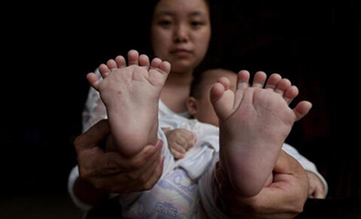 В Китае родился мальчик с 31 пальцем