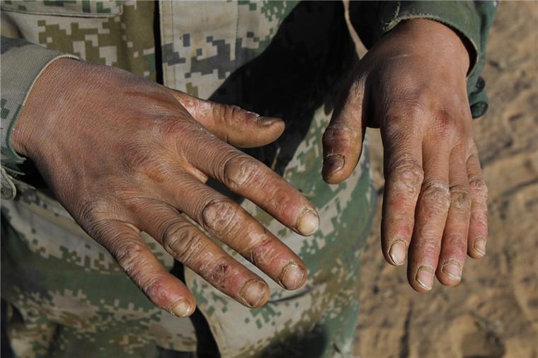 У солдат НОАК много шрамов на руках