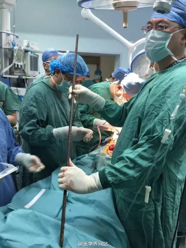 30 врачей провели семичасовую операцию для спасения мужчины, насквозь проколотого арматурой