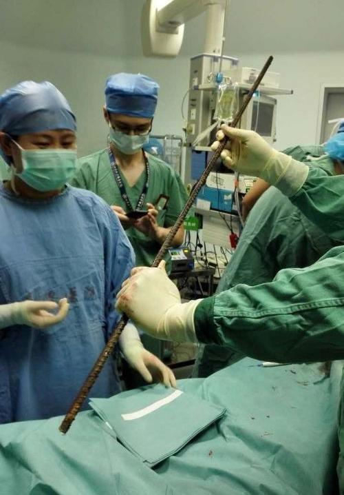 30 врачей провели семичасовую операцию для спасения мужчины, насквозь проколотого арматурой