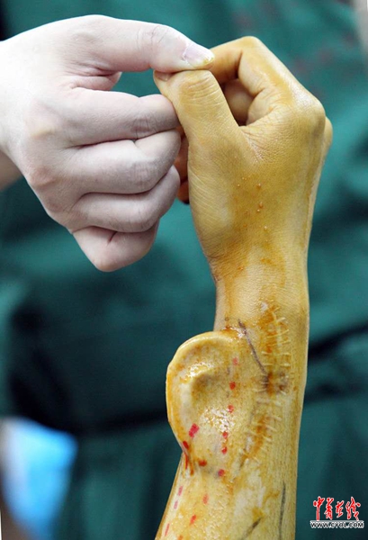 Китайские врачи успешно пересадили пациенту «выращенное» на руке ухо