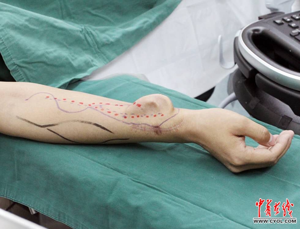 Китайские врачи успешно пересадили пациенту «выращенное» на руке ухо