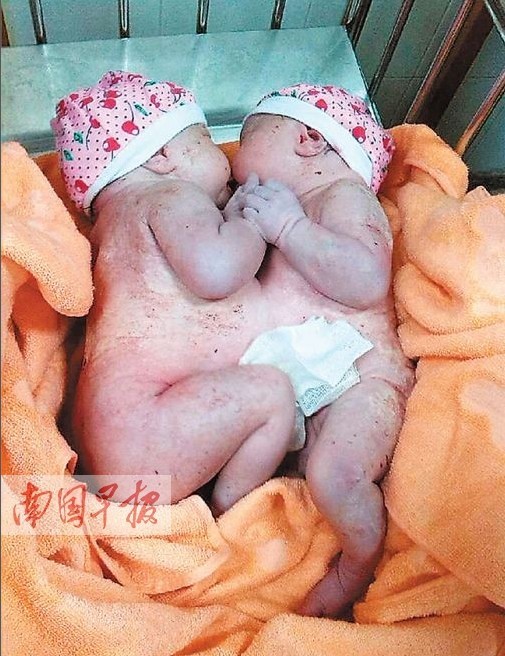 В провинции Гуанси успешно разделили сиамских близнецов