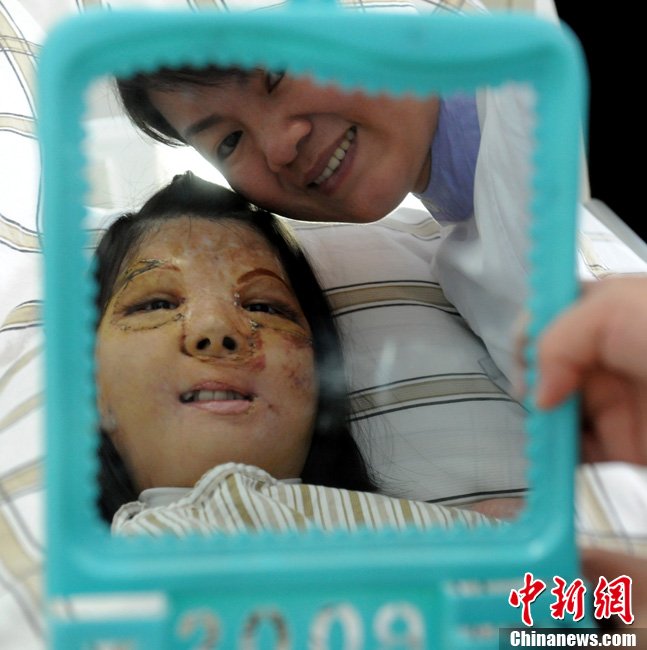 В провинции Фуцзянь успешно прошла первая операция по изменению черт лица  (2)