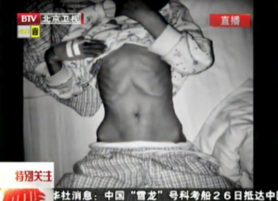 В Китае пятилетний мальчик отравился ртутью (6)