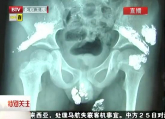 В Китае пятилетний мальчик отравился ртутью (2)