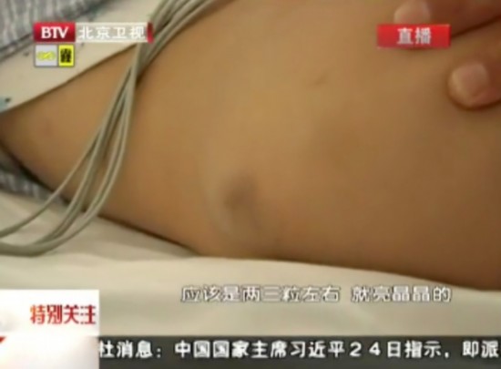 В Китае пятилетний мальчик отравился ртутью (3)