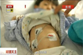 В Китае пятилетний мальчик отравился ртутью